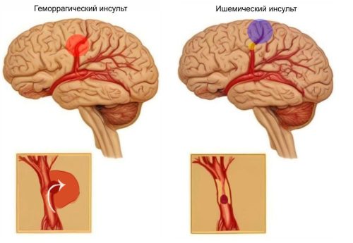 Неделя борьбы с инсультом